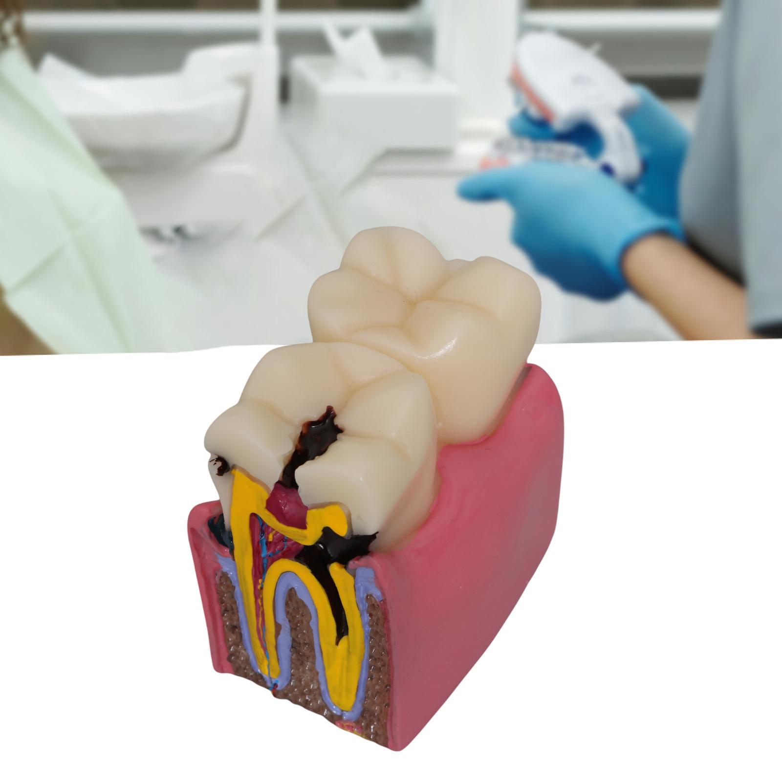 Tooth Decay Model Roots Canal  - đánh giá và giá Kids Education Classes