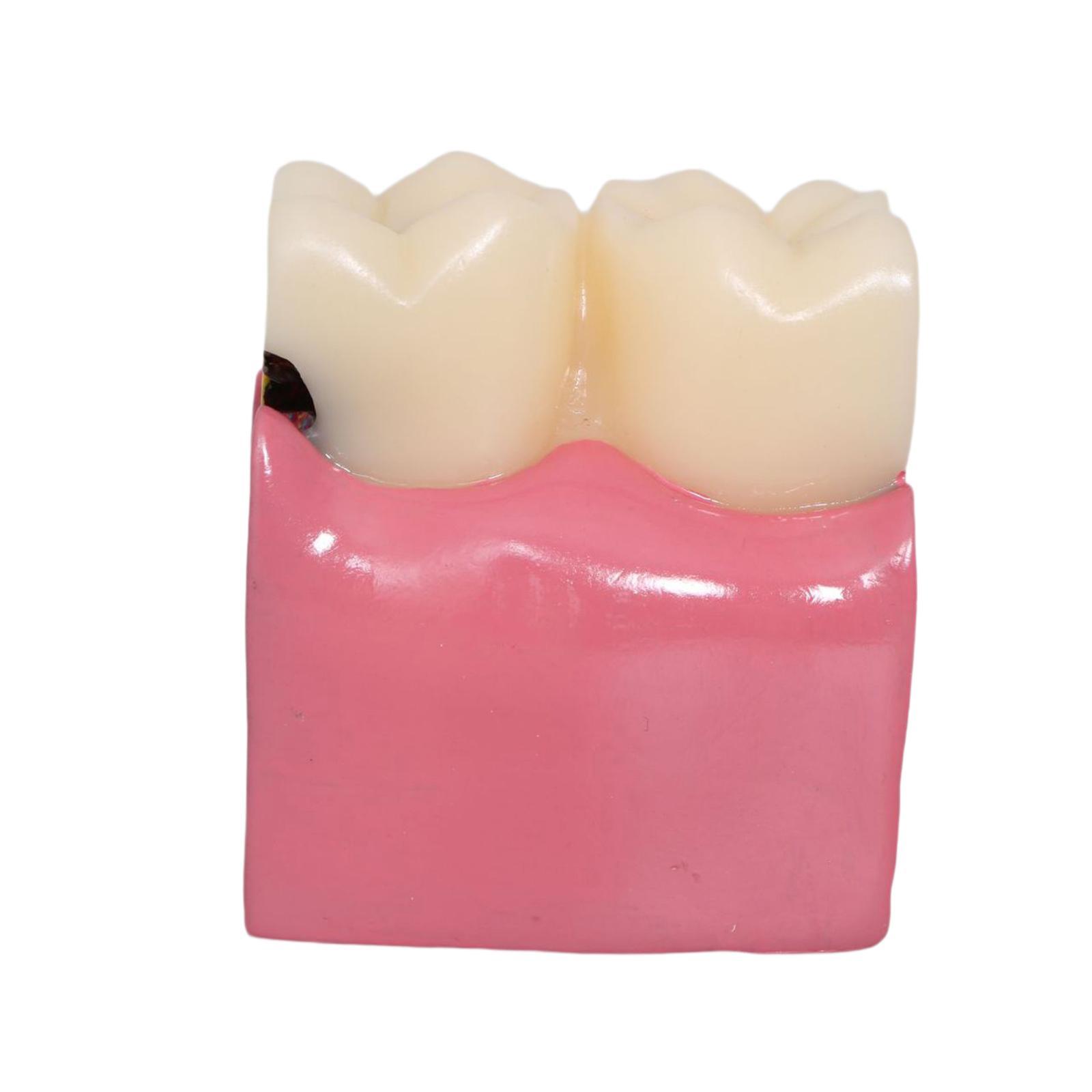 Tooth Decay Model Roots Canal  - đánh giá và giá Kids Education Classes