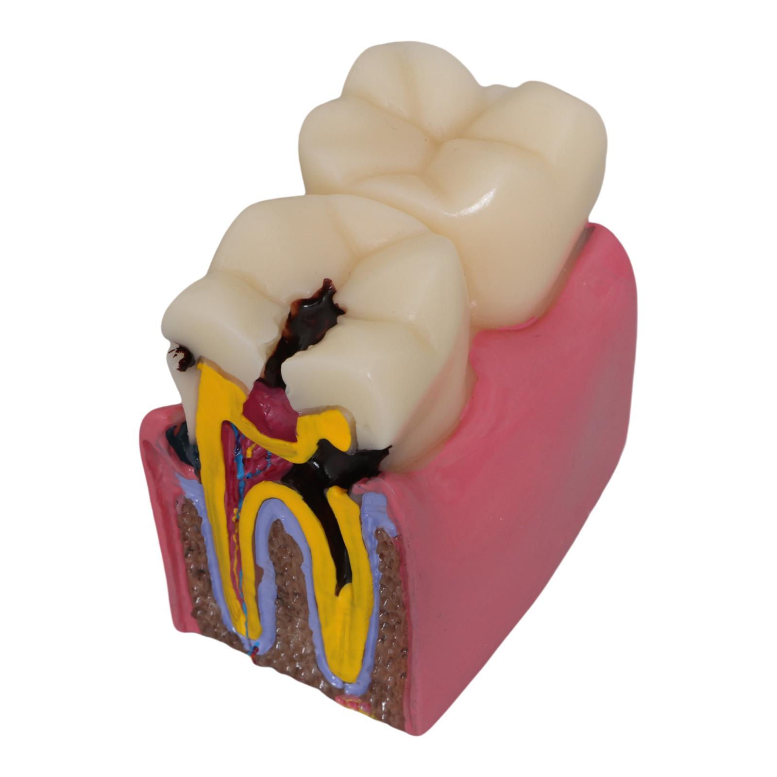 Tooth Decay Model Roots Canal  - đánh giá và giá Kids Education Classes